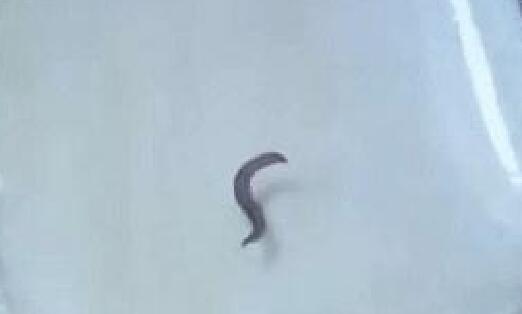 姐弟俩尿液中有黑色活虫