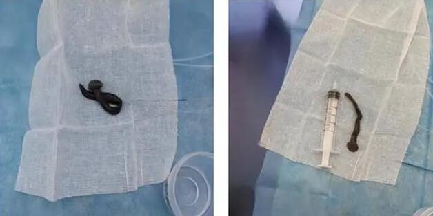 女子咳嗽半月气管发现8cm蚂蟥