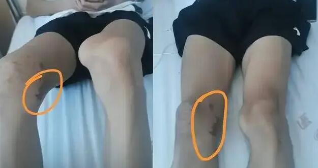 医院回应医生错切体育生膝盖