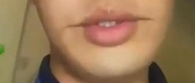 男子吃烧烤被烫出微笑唇